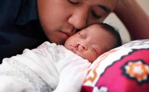 A father looks on lovingly at his baby son with cleft palette 