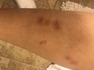 Bed bug bites