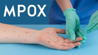 The World Health Organisation has declared recent outbreaks of Mpox as an international public health emergency.