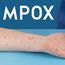 Mpox has spread to Asia with first case in Thailand