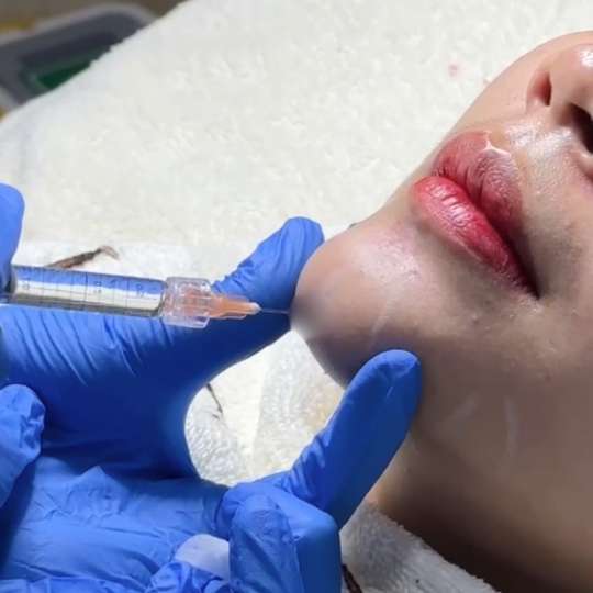 -Chin Filler Korea